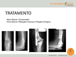 TRATAMENTO 
•Sem Desvio- Conservador 
•Com Desvio- Redução Cruenta e Fixação Cirúrgica 
 