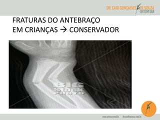 FRATURAS DO ANTEBRAÇO 
EM CRIANÇAS  CONSERVADOR 
 