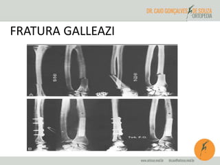 FRATURA GALLEAZI 
 
