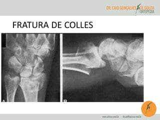 FRATURA DE COLLES 
 