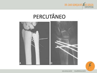 PERCUTÂNEO 
 