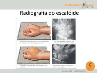 Radiografia do escafóide 
 