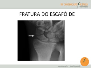 FRATURA DO ESCAFÓIDE 
 