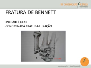 FRATURA DE BENNETT 
-INTRARTICULAR 
-DENOMINADA FRATURA-LUXAÇÃO 
 