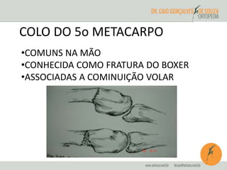 COLO DO 5o METACARPO 
•COMUNS NA MÃO 
•CONHECIDA COMO FRATURA DO BOXER 
•ASSOCIADAS A COMINUIÇÃO VOLAR 
 