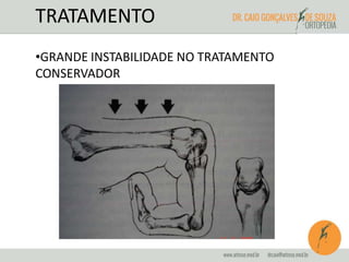 TRATAMENTO 
•GRANDE INSTABILIDADE NO TRATAMENTO 
CONSERVADOR 
 