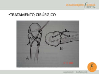 •TRATAMENTO CIRÚRGICO 
 