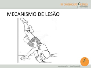 MECANISMO DE LESÃO 
 