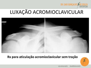LUXAÇÃO ACROMIOCLAVICULAR 
Rx para aticulação acromioclavicular sem tração 
 