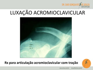 LUXAÇÃO ACROMIOCLAVICULAR 
Rx para articulação acromioclavicular com tração 
 