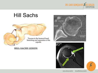 Hill Sachs 
 