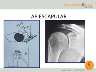 AP ESCAPULAR 
 
