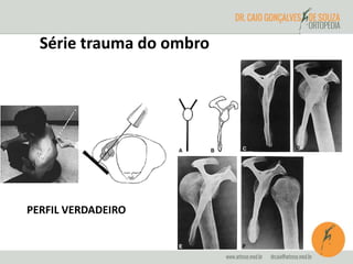 Série trauma do ombro 
PERFIL VERDADEIRO 
 