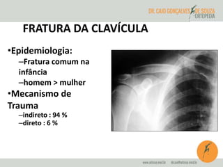 FRATURA DA CLAVÍCULA 
•Epidemiologia: 
–Fratura comum na 
infância 
–homem > mulher 
•Mecanismo de 
Trauma 
–indireto : 94 % 
–direto : 6 % 
 