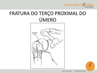 FRATURA DO TERÇO PROXIMAL DO 
ÚMERO 
 