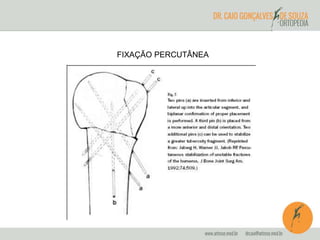 FIXAÇÃO PERCUTÂNEA 
 