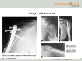 FIXAÇÃO INTRAMEDULAR 
 