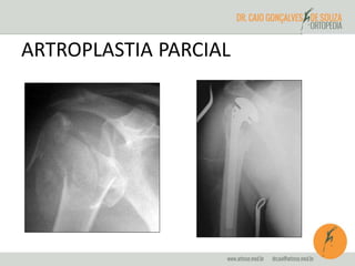 ARTROPLASTIA PARCIAL 
 