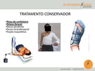 TRATAMENTO CONSERVADOR 
•Pinça de confeiteiro 
•Órtese (brace) 
•Gesso pendente 
•Gesso toracobraquial 
•Tração esquelética 
 