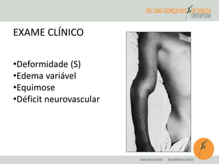 EXAME CLÍNICO 
•Deformidade (S) 
•Edema variável 
•Equimose 
•Déficit neurovascular 
 