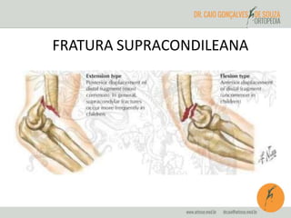 FRATURA SUPRACONDILEANA 
 