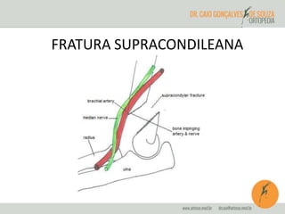 FRATURA SUPRACONDILEANA 
 