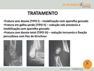 TRATAMENTO 
•Fratura sem desvio (TIPO I) – imobilização com aparelho gessado 
•Fratura em galho-verde (TIPO II) – redução sob anestesia e 
imobilização com aparelho gessado 
•Fratura com desvio total (TIPO III) – redução incruenta e fixação 
percutânea com fios de Kirschner 
 