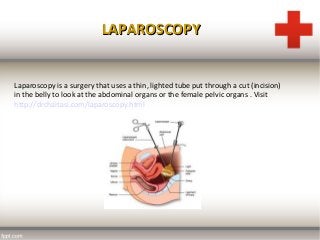LAPAROSCOPYLAPAROSCOPY
Laparoscopy is a surgery that uses a thin, lighted tube put through a cut (incision)
in the belly to look at the abdominal organs or the female pelvic organs . Visit
http://drchaitasi.com/laparoscopy.html
 