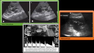 Rins Policísticos
Hidronefrose
 