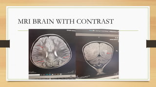 MRI BRAIN WITH CONTRAST
 