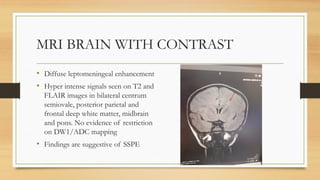 MRI BRAIN WITH CONTRAST
• Diffuse leptomeningeal enhancement
• Hyper intense signals seen on T2 and
FLAIR images in bilateral centrum
semiovale, posterior parietal and
frontal deep white matter, midbrain
and pons. No evidence of restriction
on DW1/ADC mapping
• Findings are suggestive of SSPE
 