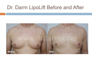 Dr. Darm LipoLift Before and After
 