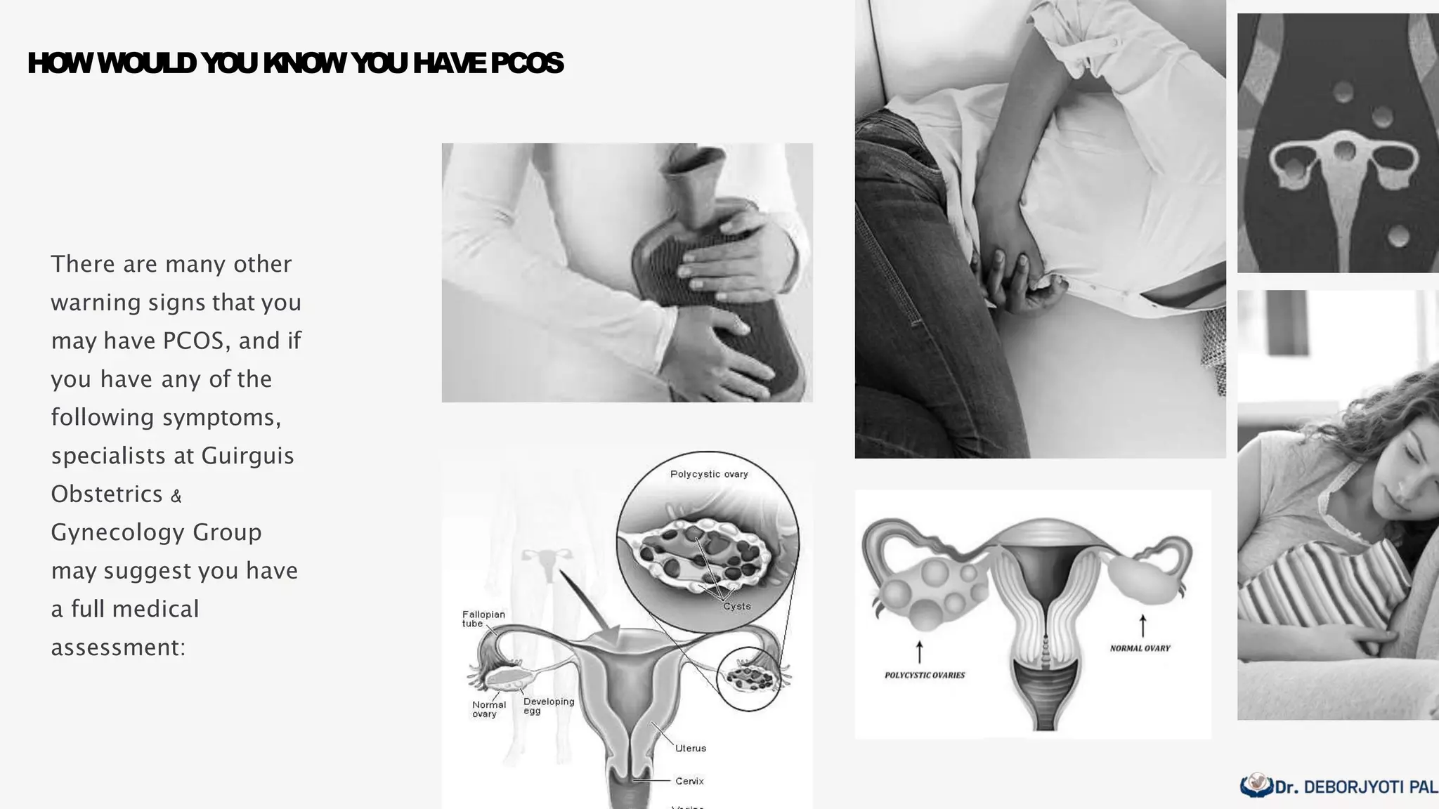 No Pcos signs of PCOS | PPTX