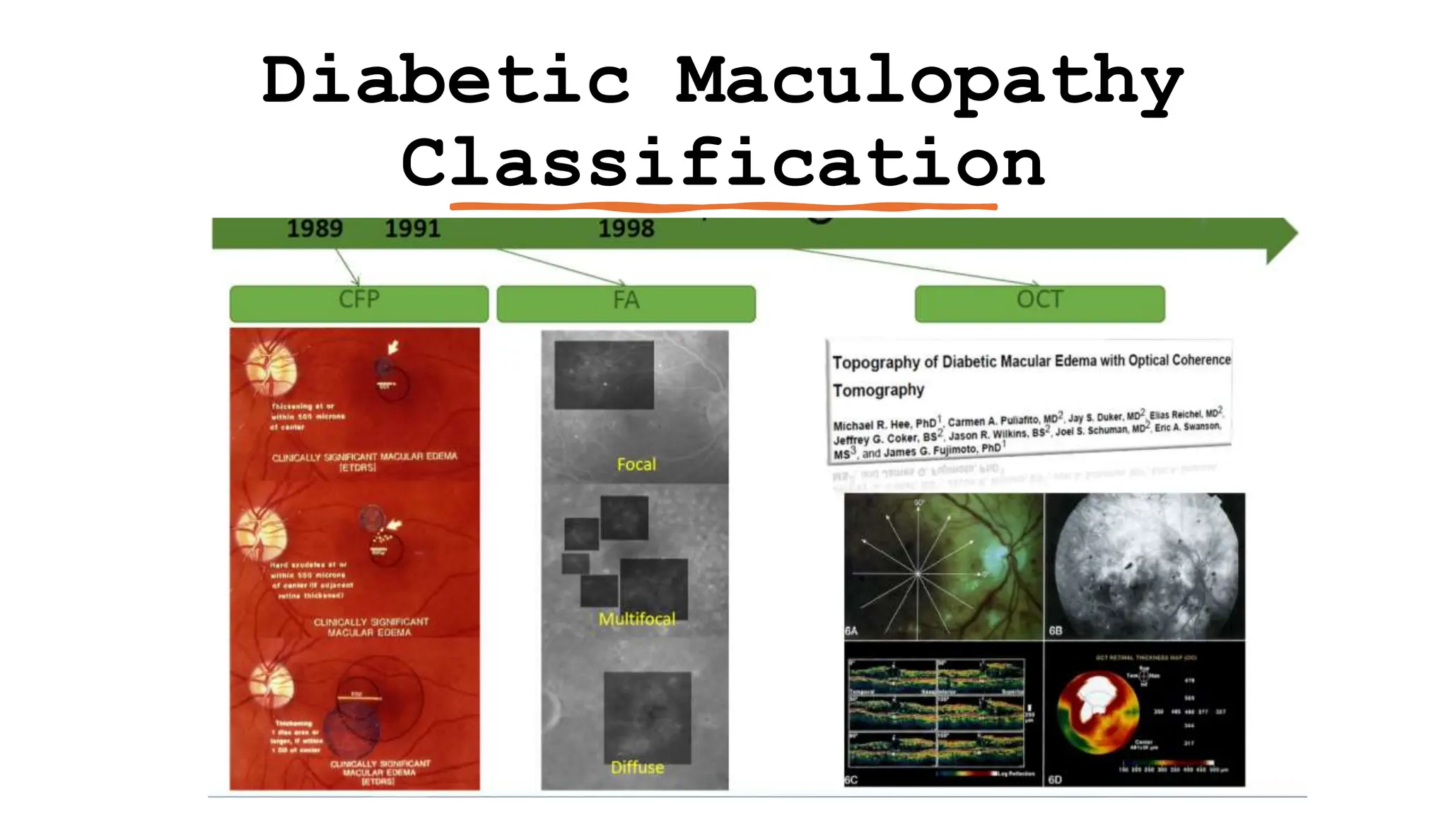 Diabetic Maculopathy
Classification
 