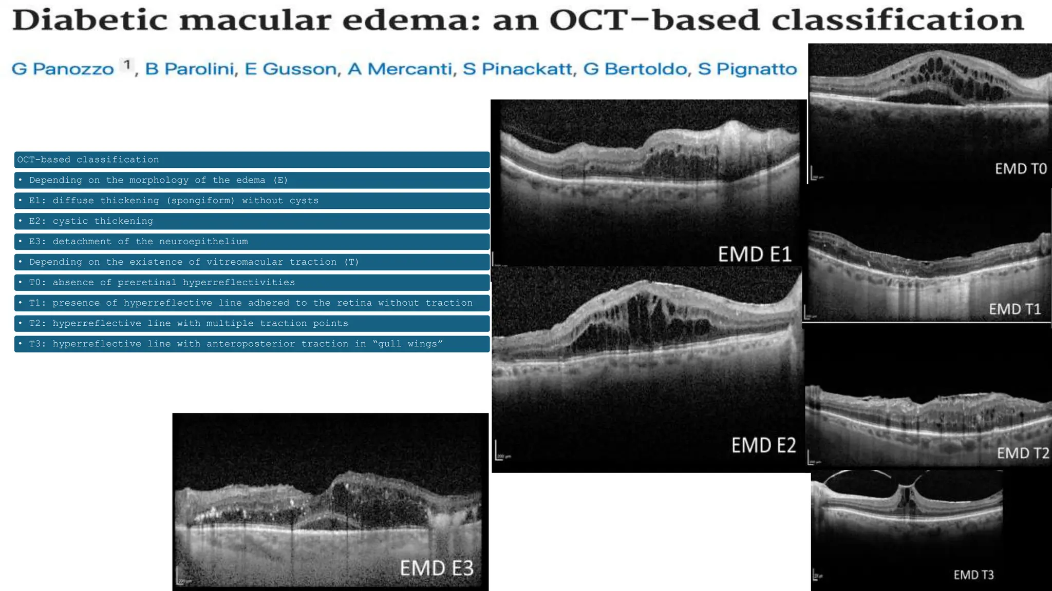 OCT-based classification
• Depending on the morphology of the edema (E)
• E1: diffuse thickening (spongiform) without cysts
• E2: cystic thickening
• E3: detachment of the neuroepithelium
• Depending on the existence of vitreomacular traction (T)
• T0: absence of preretinal hyperreflectivities
• T1: presence of hyperreflective line adhered to the retina without traction
• T2: hyperreflective line with multiple traction points
• T3: hyperreflective line with anteroposterior traction in “gull wings”
 