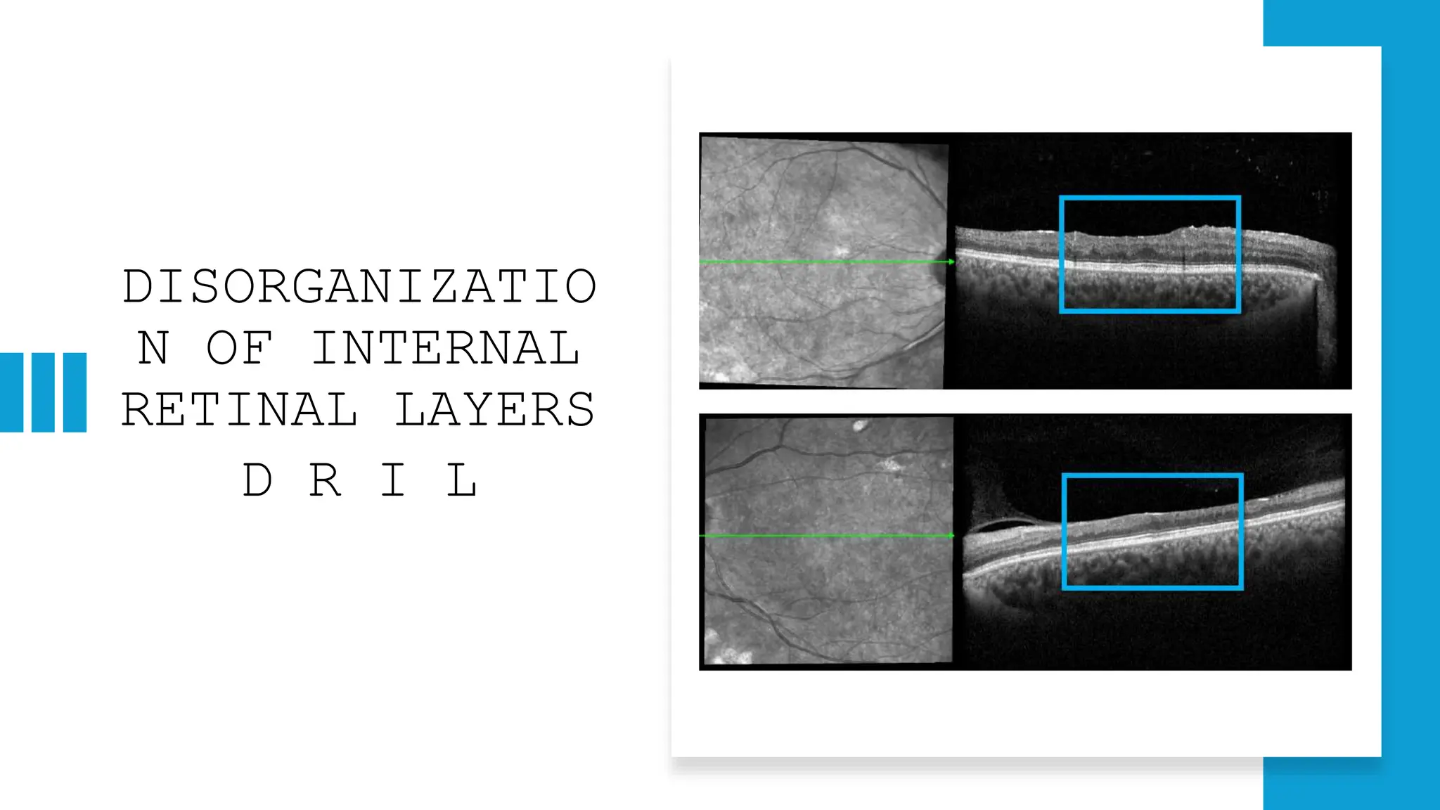 DISORGANIZATIO
N OF INTERNAL
RETINAL LAYERS
D R I L
 