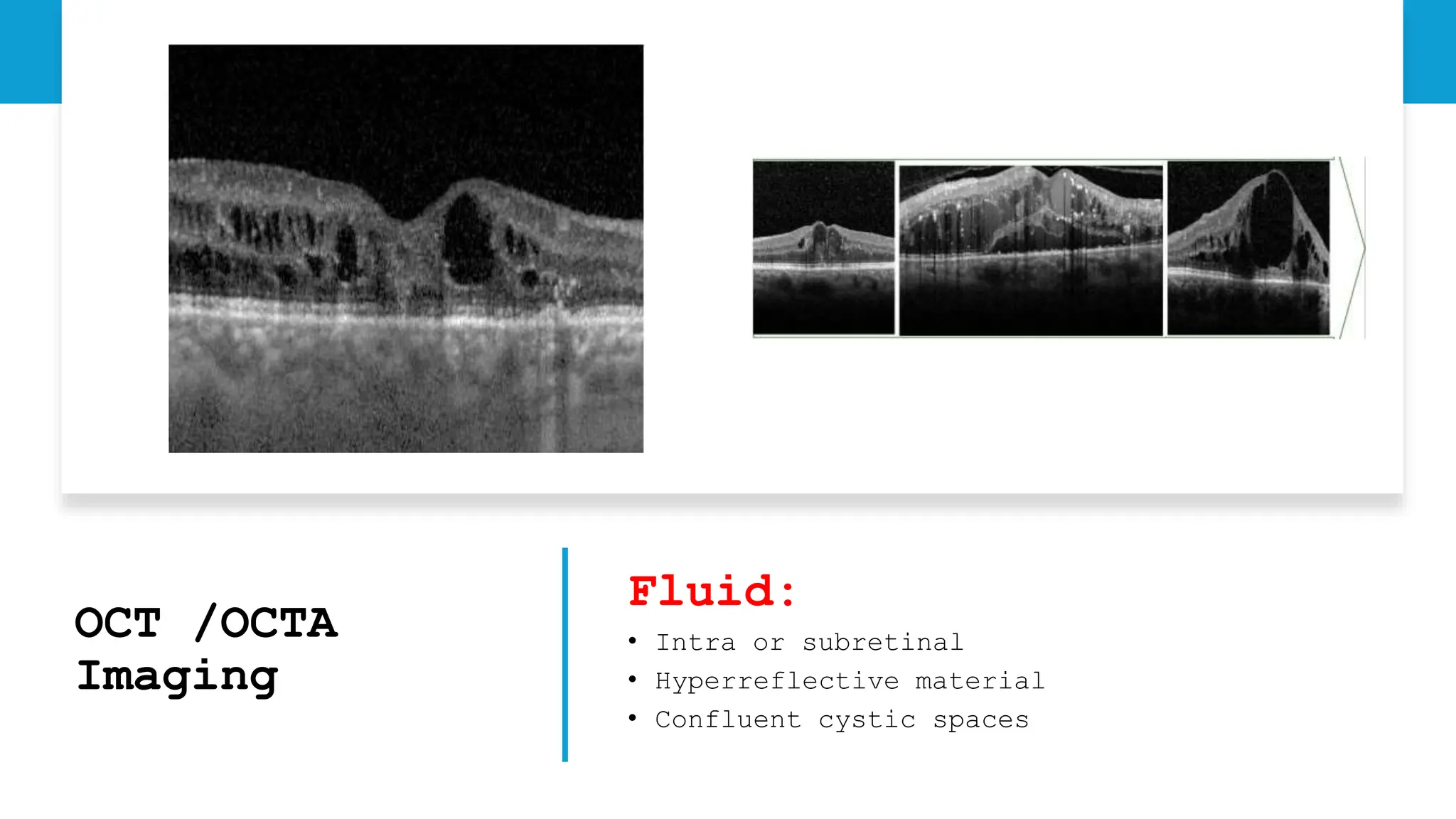OCT /OCTA
Imaging
Fluid:
• Intra or subretinal
• Hyperreflective material
• Confluent cystic spaces
 