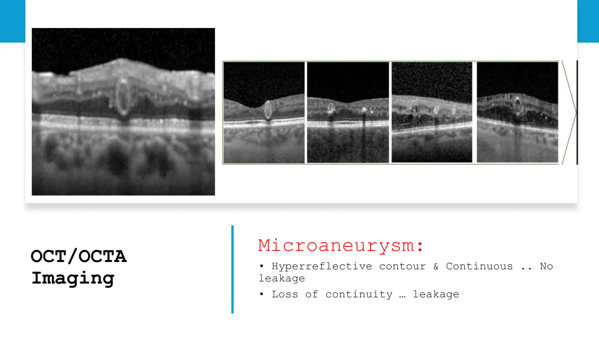 OCT/OCTA
Imaging
Microaneurysm:
• Hyperreflective contour & Continuous .. No
leakage
• Loss of continuity … leakage
 