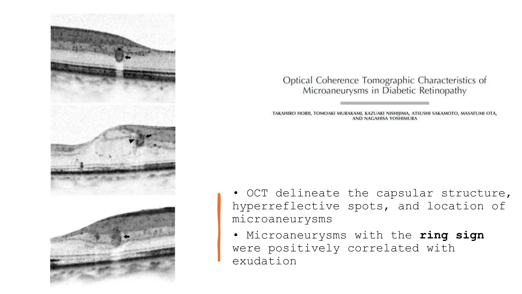 • OCT delineate the capsular structure,
hyperreflective spots, and location of
microaneurysms
• Microaneurysms with the ring sign
were positively correlated with
exudation
 