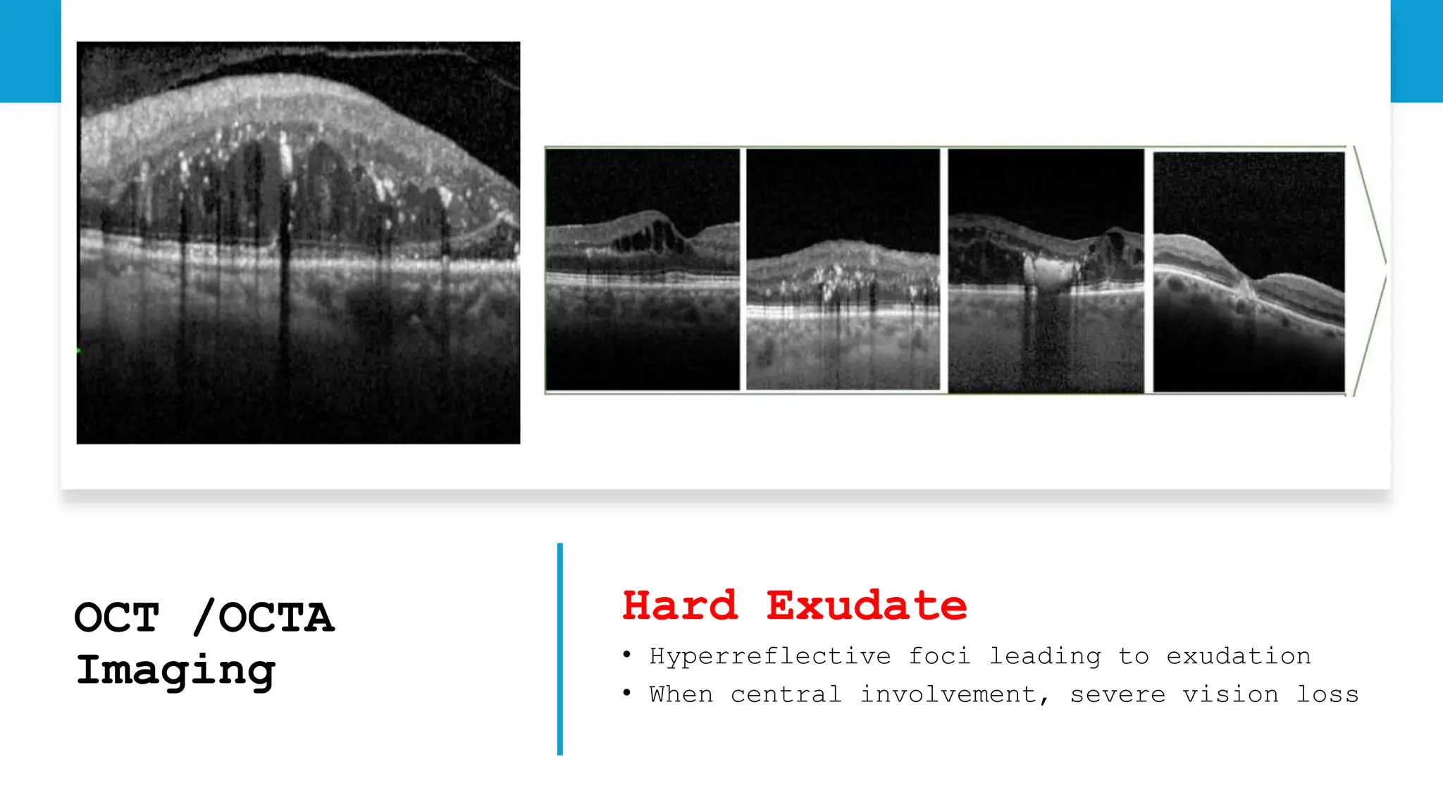 OCT /OCTA
Imaging
Hard Exudate
• Hyperreflective foci leading to exudation
• When central involvement, severe vision loss
 