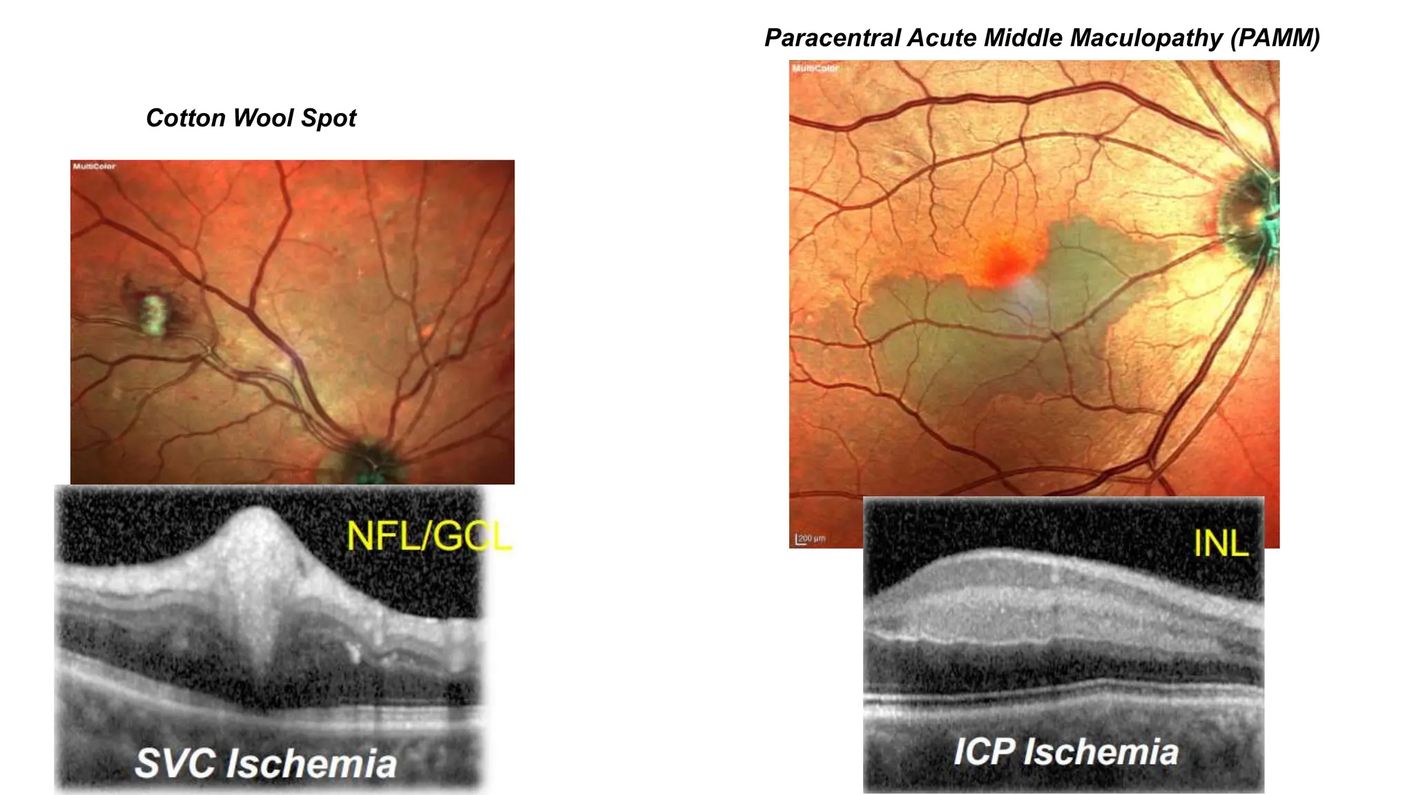 Cotton Wool Spot
Paracentral Acute Middle Maculopathy (PAMM)
 