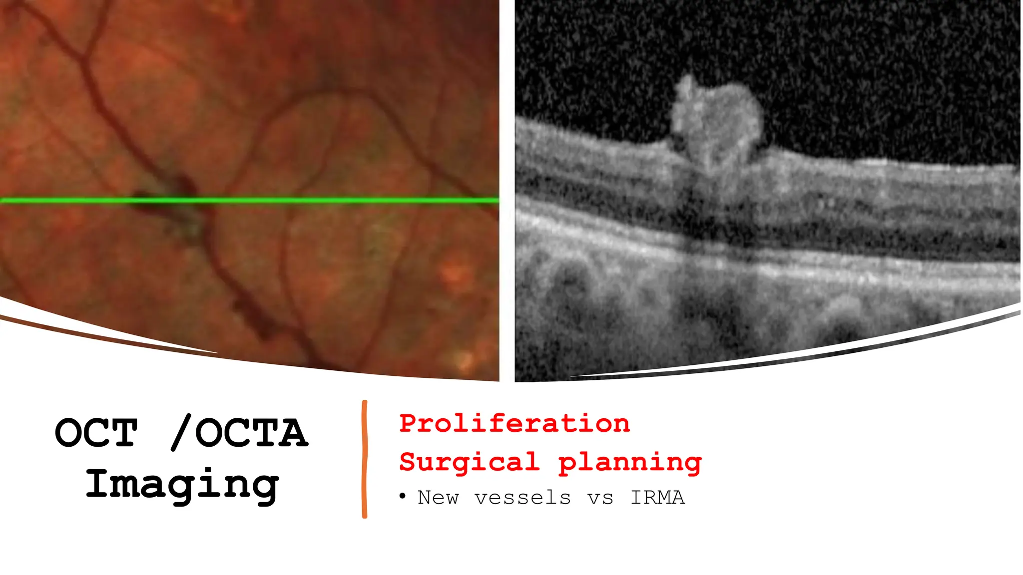 OCT /OCTA
Imaging
Proliferation
Surgical planning
• New vessels vs IRMA
 