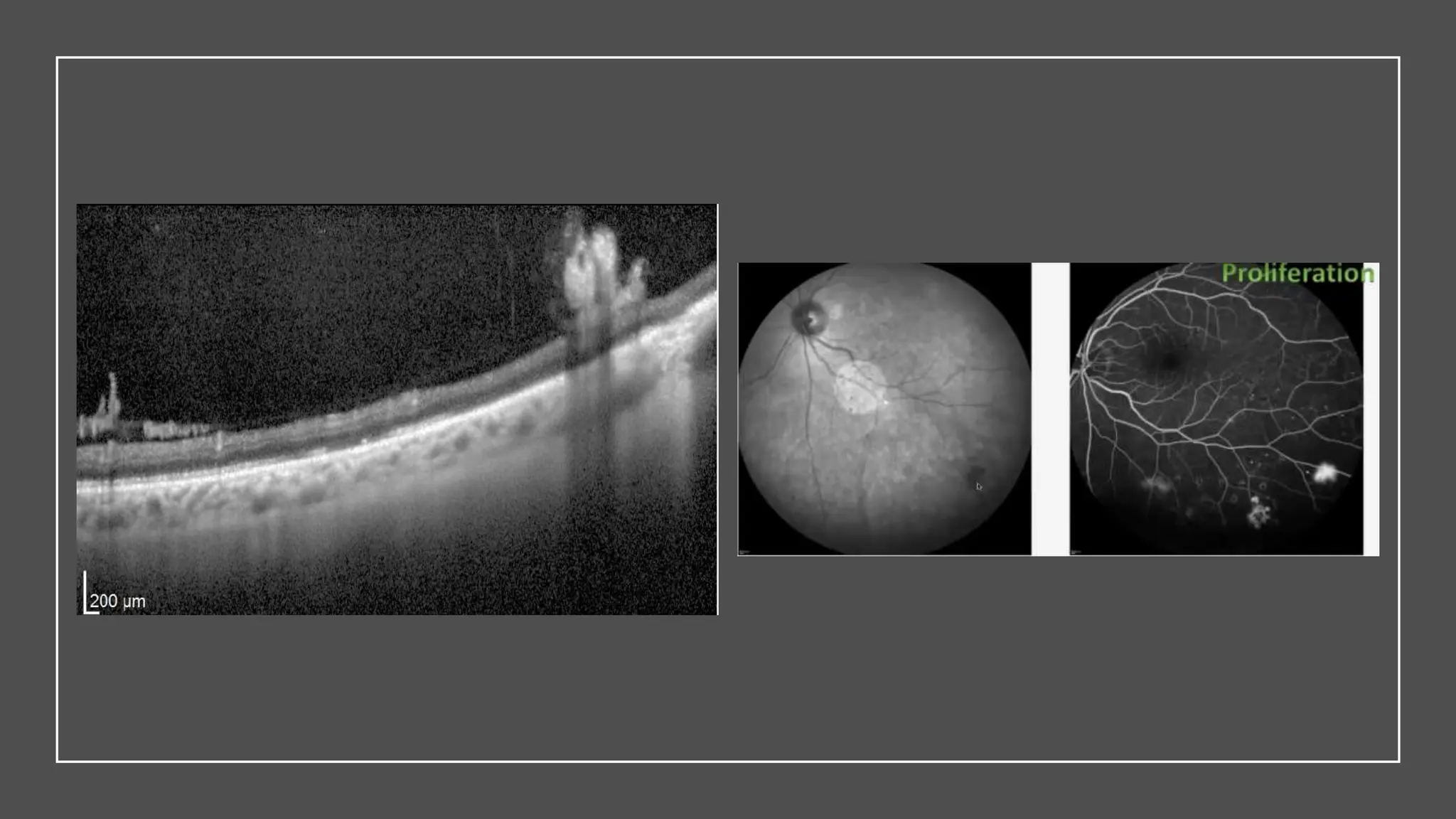 Navigating the Complexities of  Diabetic Retinopathy