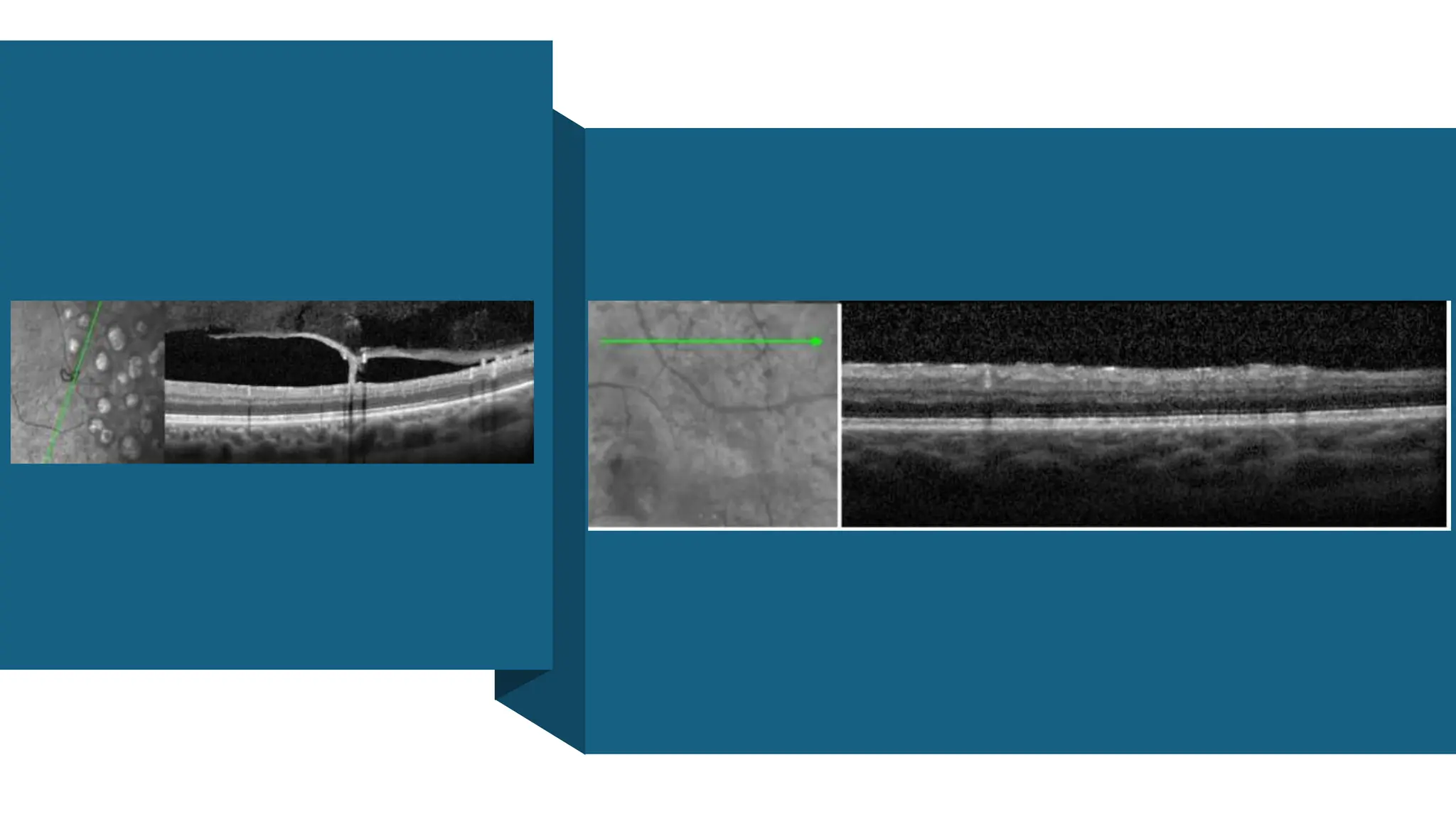 Navigating the Complexities of  Diabetic Retinopathy