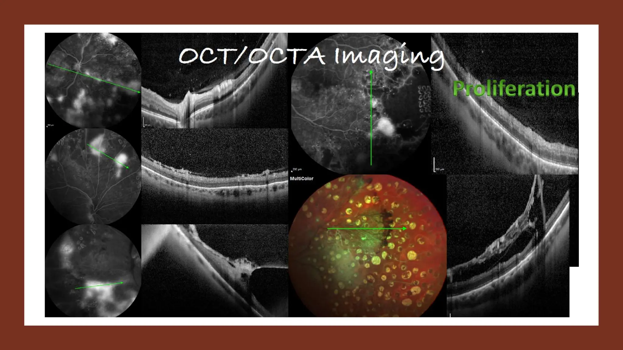 Navigating the Complexities of  Diabetic Retinopathy