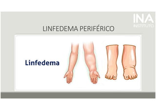 LINFEDEMA PERIFÉRICO
LINFEDEMA PERIFÉRICO
LINFEDEMA PERIFÉRICO
LINFEDEMA PERIFÉRICO
 