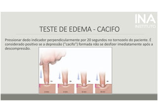 TESTE DE EDEMA
TESTE DE EDEMA
TESTE DE EDEMA
TESTE DE EDEMA -
-
-
- CACIFO
CACIFO
CACIFO
CACIFO
Pressionar dedo indicador perpendicularmente por 20 segundos no tornozelo do paciente. É
considerado positivo se a depressão ("cacifo") formada não se desfizer imediatamente após a
descompressão.
 