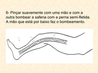 6- Pinçar suavemente com uma mão e com a
outra bombear a safena com a perna semi-fletida.
A mão que está por baixo faz o bombeamento.
 