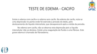 TESTE DE EDEMA - CACIFO
Existe o edema com cacifo e o edema sem cacifo. No edema de cacifo, nota-se
uma depressão no ponto onde foi exercida a pressão do dedo, pelo
deslocamento do líquido intercelular, que desaparecerá após a retida da pressão.
No edema sem cacifo, não se observa esta depressão pois o liquido
intercelular não se desloca. Existe uma coagulação do fluido e uma fibrose. Este
grave edema é chamado de fibroedema.
 