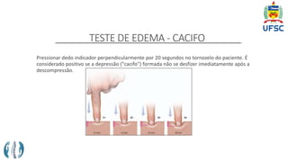 TESTE DE EDEMA - CACIFO
Pressionar dedo indicador perpendicularmente por 20 segundos no tornozelo do paciente. É
considerado positivo se a depressão ("cacifo") formada não se desfizer imediatamente após a
descompressão.
 